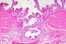 Rokitansky-Aschoff Sinus, Gallbladder Adenomyomatosis Rokitansky-Aschoff Sinus, Gallbladder (3704042567).jpg