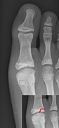 Salter–Harris III fracture of big toe proximal phalanx.