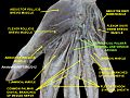 Superficial palmar arterial and venous arche