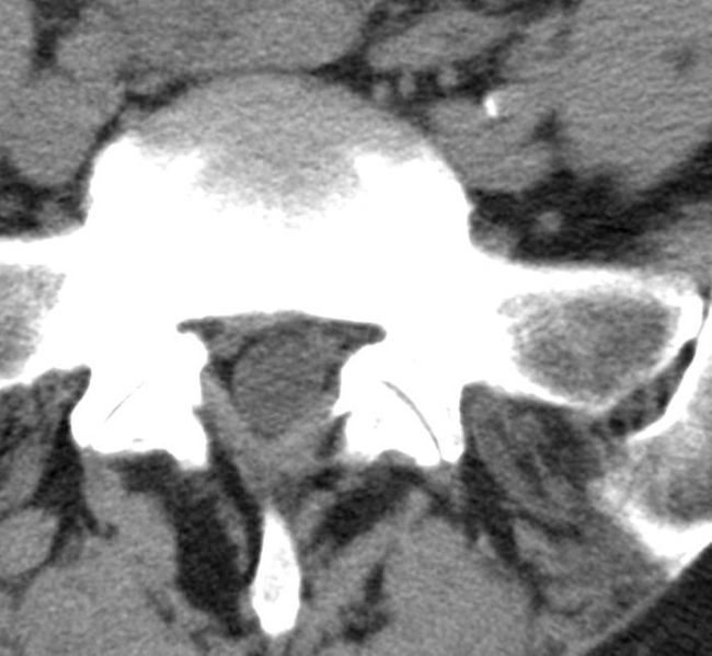 File:Spondylarthrose2.jpg