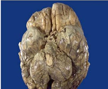 Tuberculous-meningitis-autopsy, showing associated brain oedema and congestion