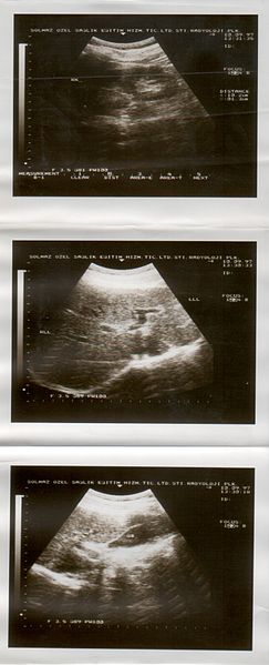 File:Ultrasound Scan ND 199.jpg