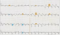 L'ECG mostra un sopraslivellamento di ST con Tachicardia, Emiblocco anteriore sinistro, Infarto miocardico anteriore (attacco cardiaco). Legenda: ST sopralivellato nelle derivazioni anteriori DI, aVL, V1, V2, V3, V4, V5, ST sottolivellato nelle derivazioni inferiori DII, DIII, aVF