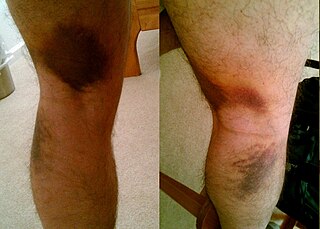 Pulled hamstring