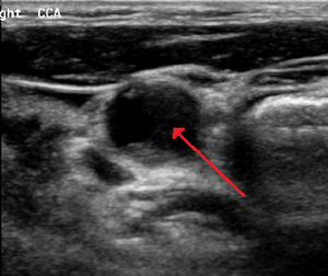 Carotid Artery Stenosis