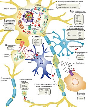 Amyotrophic Lateral Sclerosis Wikipedia