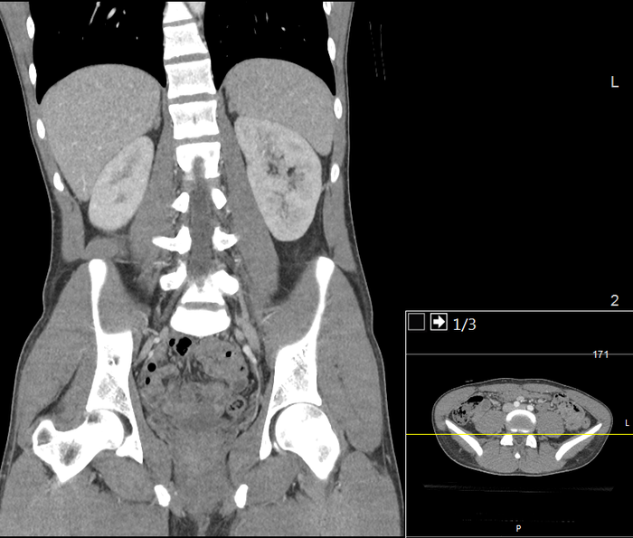 CT of a normal abdomen and pelvis, coronal plane 87.png