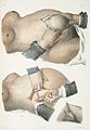 Caesarean methods..JPG