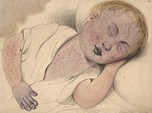 Child with congenital heart disease with central cyanosis that is worsened by measles. Note the bluish-purple discoloration of the fingernails, lips, eyelids, and nose, along with prominent nail clubbing. Child with measles modified by cyanosis Wellcome L0061496.jpg