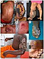 Clinical presentation of skin NTDs tropicalmed-03-00120-g001.jpg