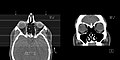 CT scan of the paranasal sinuses with coronal reconstruction (right) and axial planning data (left).