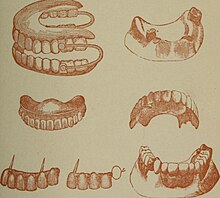 Dental prosthesis (1893).jpg