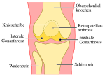 Vorschaubild für Kniegelenksarthrose