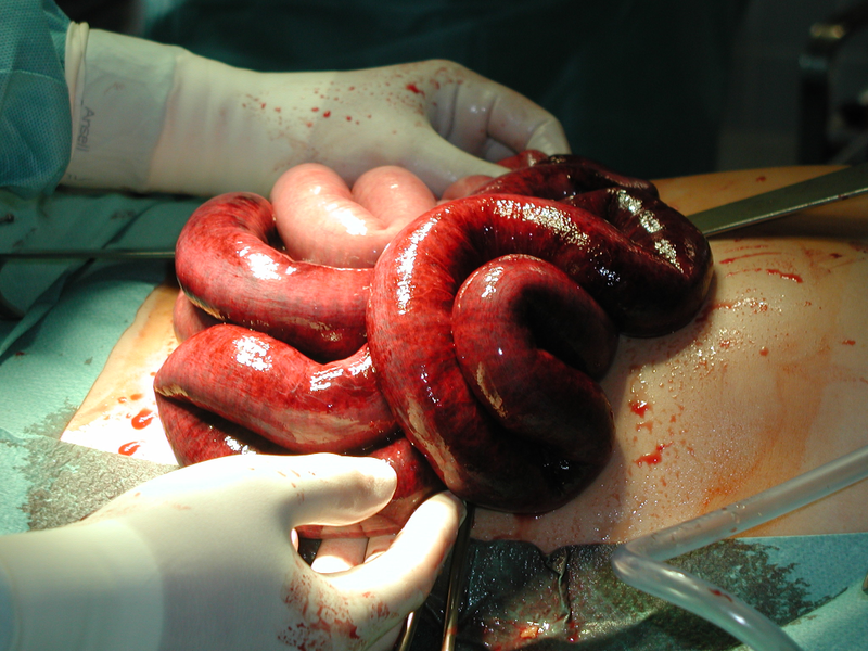 File:Ileus2.png