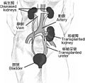 腎移植のサムネイル