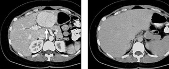 FIGURE 6. Selected images from a biphasic CT of Focal Nodular Hyperplasia in the left hepatic lobe (arrow). These masses have characteristic early arterial enhancement (6a) with contrast wash out on the portal venous phase images (6b) from the mass making these lesions difficult to identify on portal venous phase images alone. Late arterial and portal venous phase CT of focal nodular hyperplasia.jpg