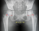 Reimer's migration index can be used to indicate hip dislocation. The migration index (MI) is normally less than 33%. Migrationsindex nach Reimers.png