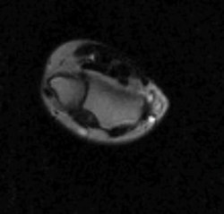 Файл: Магнитно-резонансно изобразяване в реално време (MRI) -по време на активно движение на китката - Първоначални наблюдения-поне.0084004.s002.ogv
