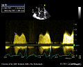 Mitral stenosis