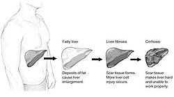 Stage of liver damage.JPG