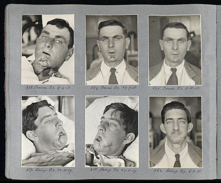 File:Album of photographs of plastic surgery cases Wellcome L0044782.jpg