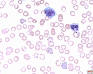 <span class="mw-page-title-main">Basophilic stippling</span> Cytoplasmic granules in basophils