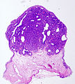 Histopathology representing an inverted papilloma of the urinary bladder that was cystoscopically resected. Hematoxylin and eosion stain.