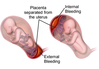 Placental abruption placenta disease that is characterized by separation of the placental lining from the uterus of the mother