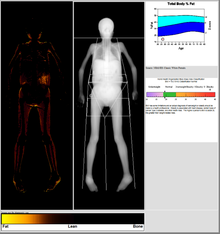 How Do DEXA Scans Work? The Science Behind Bone Mineral Density Tests