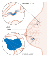 Diagram showing ductal carcinoma in situ (DCIS)[12]