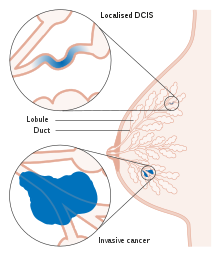 Ductalis tumor papilloma
