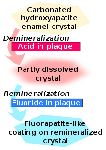 El cristal del esmalte de hydroxyapatita carbonatada es desmineralizado por el ácido en la plaqueta y se convierte en un cristal parcialmente disuelto. A su vez, éste es remineralizado por el fluoruro en la placa para convertirse en un revestimiento similar a la fluorapatita en el cristal remineralizado.