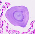 Miniatura para Microlitiasis alveolar pulmonar