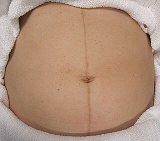 <span class="mw-page-title-main">Linea nigra</span> Dark vertical line that appears on the abdomen during pregnancy