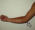Thumbnail for Ulnar collateral ligament injury of the elbow