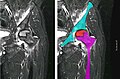 Nuclear magnetic resonance of avascular necrosis of left femoral head. Man of 45 years with AIDS.