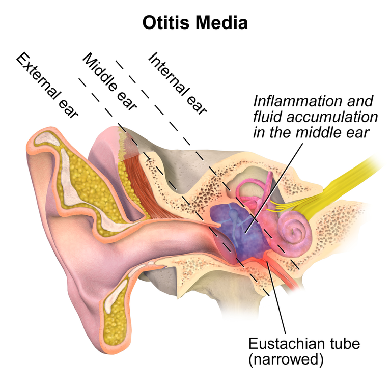 Otitis Media (Ear Infection)