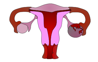 This image depicts a set of ovaries, one of which is normally functioning (left), and healthy, whilst the other one is suffering apoplexy, or the hemorrhaging of an organ. The ovary on the right's surface has been breached, and is bleeding. It has been cut off from the body's supply of nutrients and necrosis has set in. Apoplexy can also happen in the brain and the stomach. Ovarian Apoplexy.svg