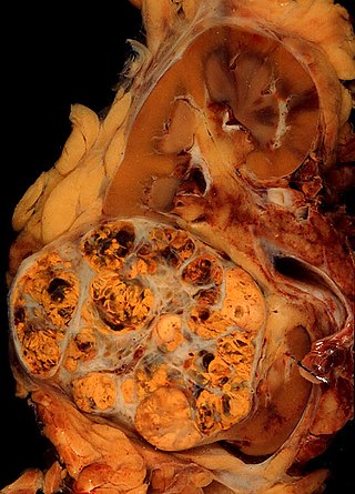 Renal cell carcinoma.