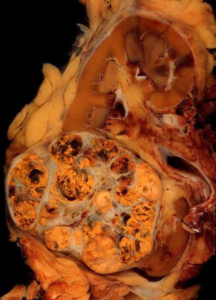 File:Renal cell carcinoma.jpg