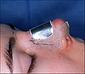 الصورة ج. عملية تجميل الأنف المفتوحة: تساعد جبيرة الأنف المعدنية في التئام الجروح من خلال حماية الأنسجة الرقيقة للأنف الجديد.