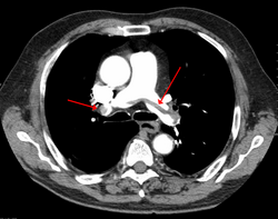 Kontrasztanyagos mellkas CT felvételen látható "lovagló embolus" a tüdőartériák elágazásában (nyíl).