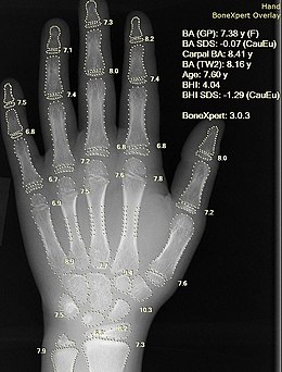 X-ray of hand, where bone age is automatically found by BoneXpert software.jpg