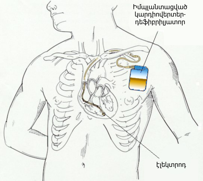 File:AICD (hy).png