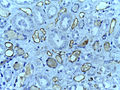 Acute humoral rejection IHC for C4D.jpg