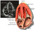 Septum Interventriculare