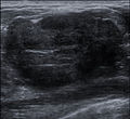 Breast Ultrasound of Fibroadenoma