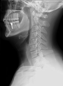 Neck Xray Lateral View