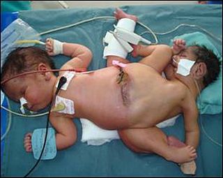 <span class="mw-page-title-main">Ischiopagi</span> Conjoined twins fused at the pelvis