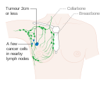 Diagram showing stage 1B breast cancer CRUK 202.svg